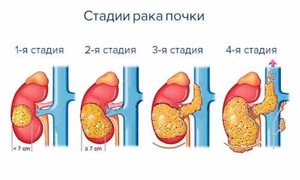 стадии рака почки