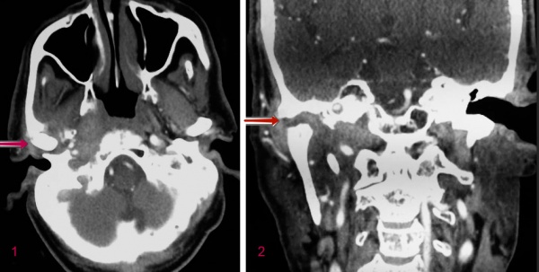 КТ больного со злокачественным наружным отитом. Эрозия височно-нижнечелюстного сустава и непрозрачность мягких тканей барабанной полости. 1 - аксиальная, 2 – корональная