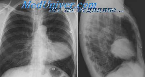 неврогенные опухоли средостения