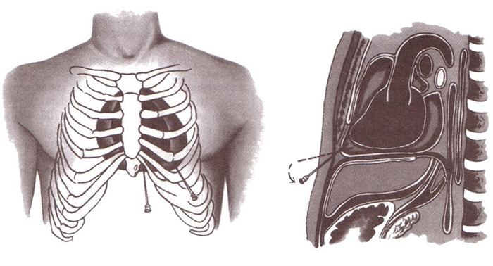 Средостение