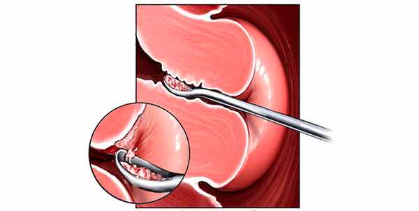Выскабливание полости матки