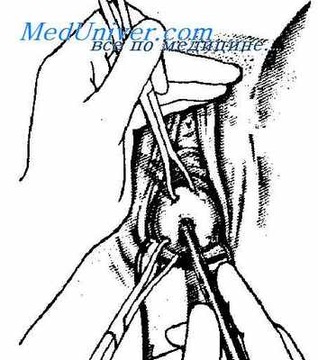 выскабливание матки