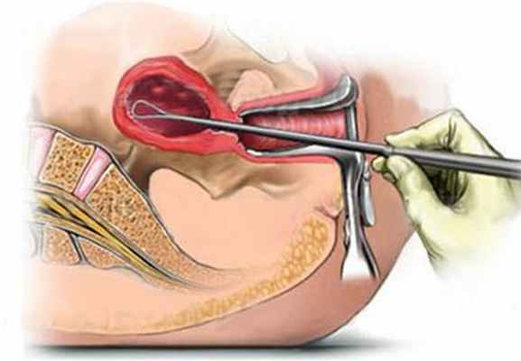 Диагностическое выскабливание полости матки