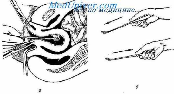 выскабливание матки