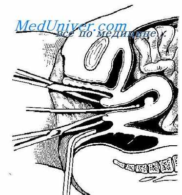 зондирование матки