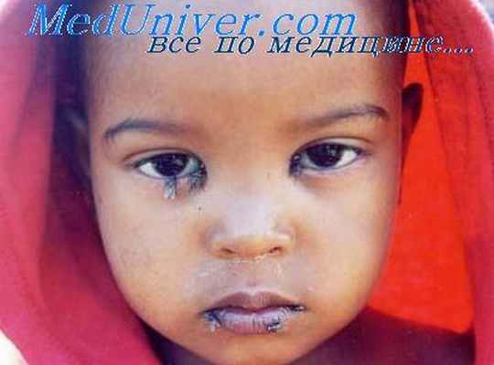 трахома глаз