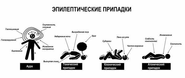 Приступы эпилепсии.jpg
