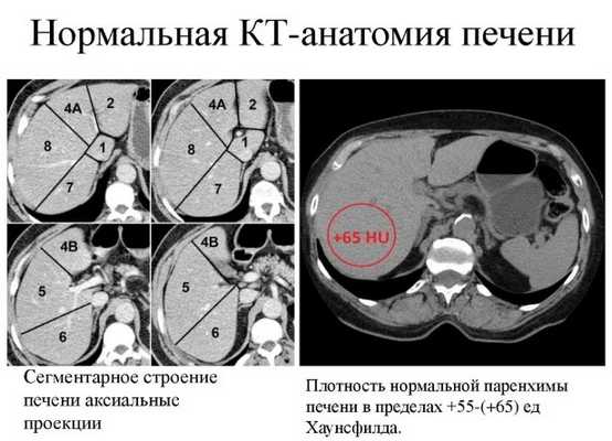 Норма КТ печени