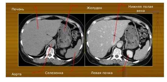 КТ органов брюшной полости