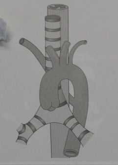 Снимки МРТ и КТ. Аберрантная левая подключичная артерия 