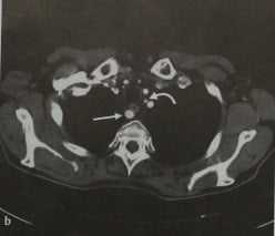 Снимки МРТ и КТ. Аберрантная левая подключичная артерия 