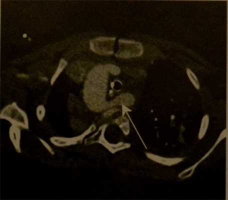 Снимки МРТ и КТ. Аберрантная правая подключичная артерия