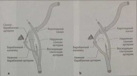 Снимки МРТ и КТ. Аберрантная внутренняя сонная артерия