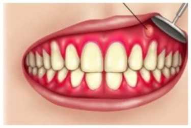 Абсцесс десны: причины, симптомы и лечение, Северо-Восточный Стоматологический Центр №1