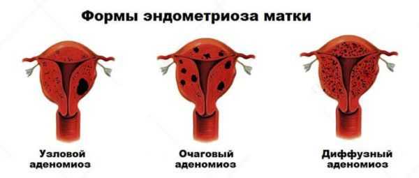 Формы эндометриоза матки