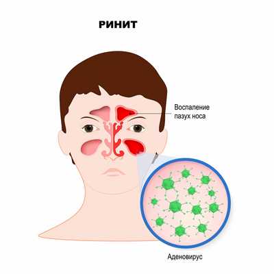 Аденовирусный энцефалит