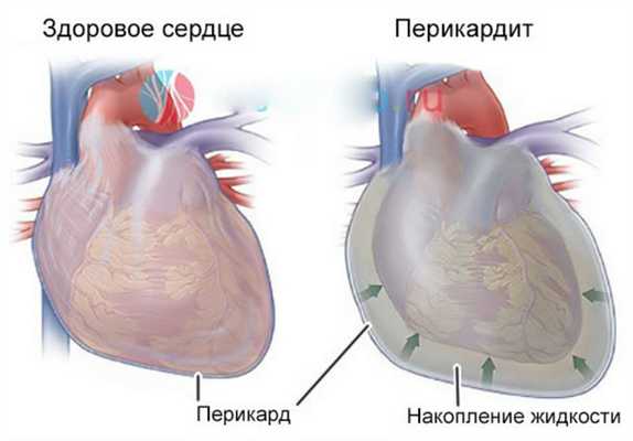 Гнойное воспаление перикарда