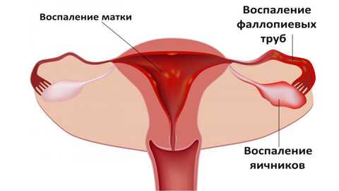 воспаление придатков