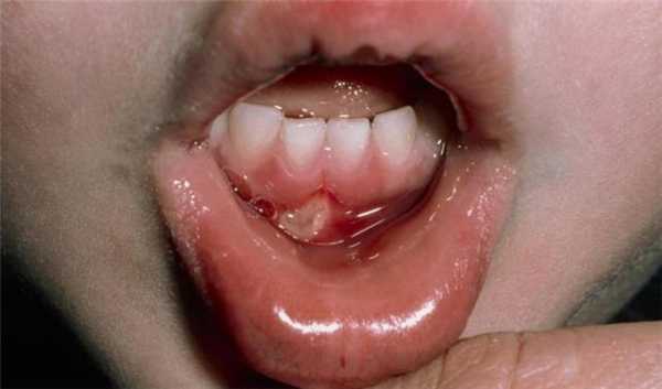 Отсрый афтозный стоматит у ребенка