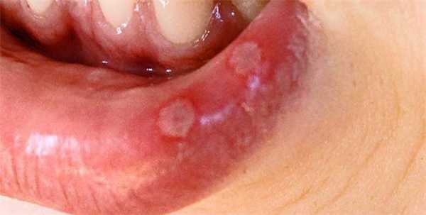 Хронический афтозный стоматит у ребенка