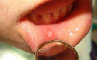 Афта во рту