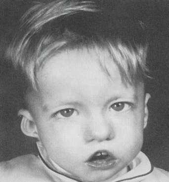 синдром Ди Джорджи