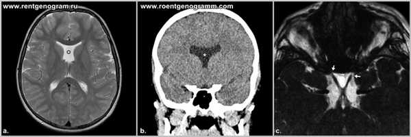 septooptic-displasiya-mri