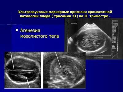 ультразвуковое исследование плода