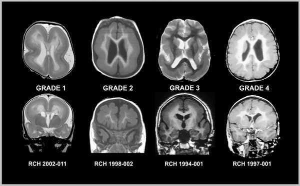 lissencephalia-3