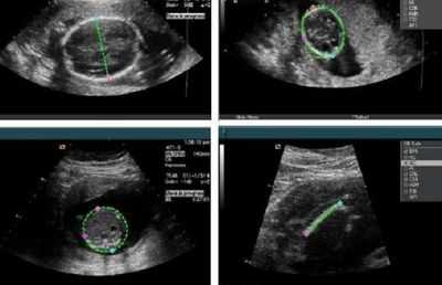 агенезия на МРТ