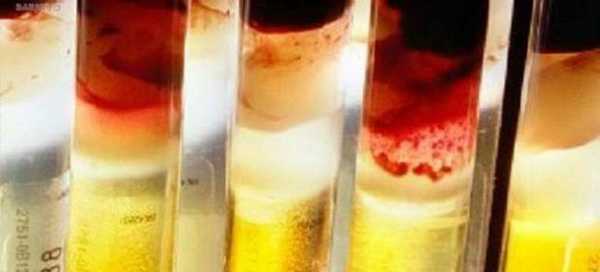 снижение агрегации тромбоцитов