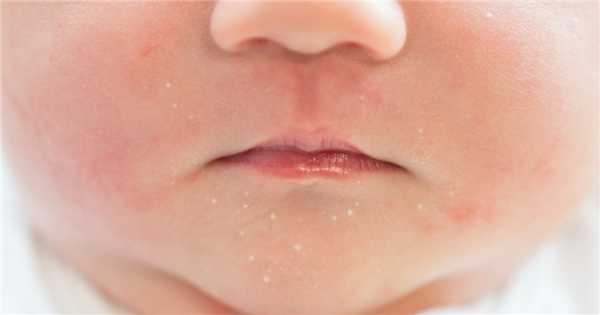 Лечение акне у ребенка