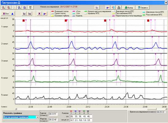 Манометрическое исследование процесса глотания