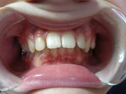 Нарушение окклюзии челюстей в сагиттальной и вертикальной плоскостях.