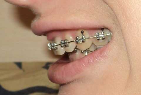 Брекет-система на зубах взрослых для исправления дизокклюзии.