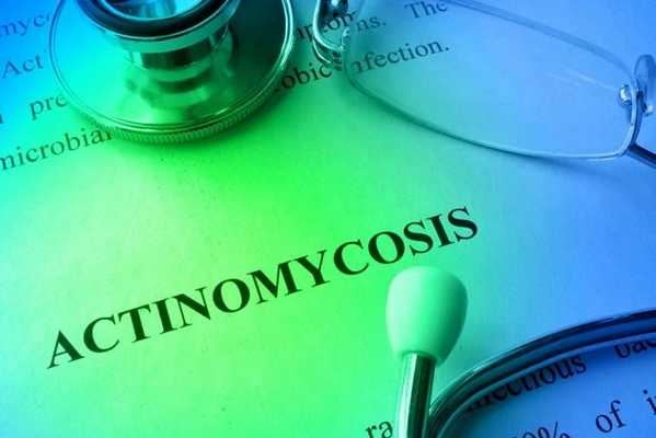 актиномикоз