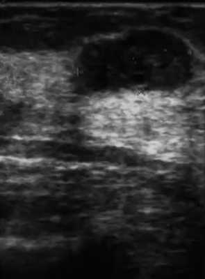 УЗ-характеристика крупной фиброаденомы