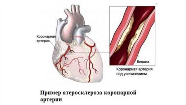 Атероскероз