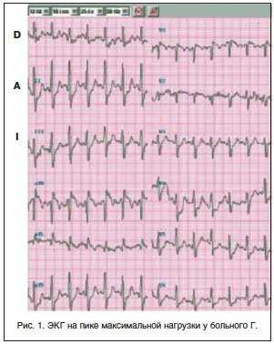 Тактика лечения стабильной стенокардии