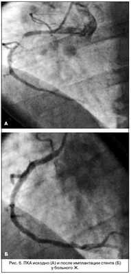 Тактика лечения стабильной стенокардии