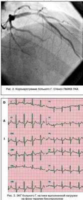 Тактика лечения стабильной стенокардии