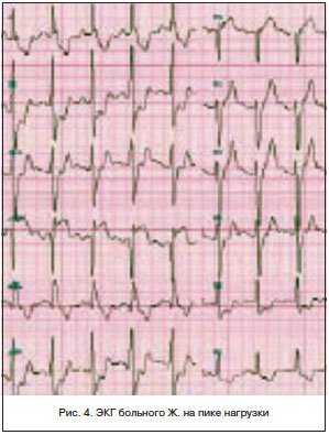 Тактика лечения стабильной стенокардии