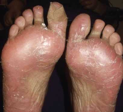 Ладонно-подошвенный синдром2.jpg