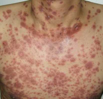 Синдром Стивена.jpg