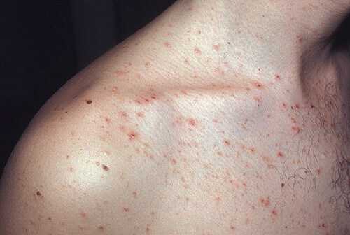 Акнеподобная сыпь 1.jpg