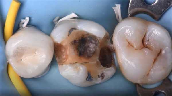 Что такое deep margin elevation или что делать если кариес ниже некуда?