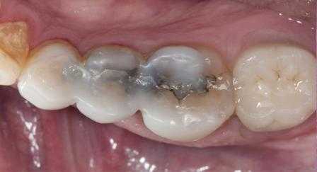 Реставрация по типу Vonlay: консервативная эстетическая альтернатива коронкам