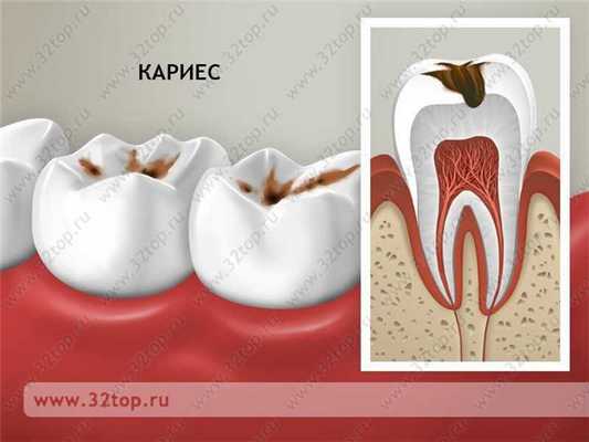 Кариес