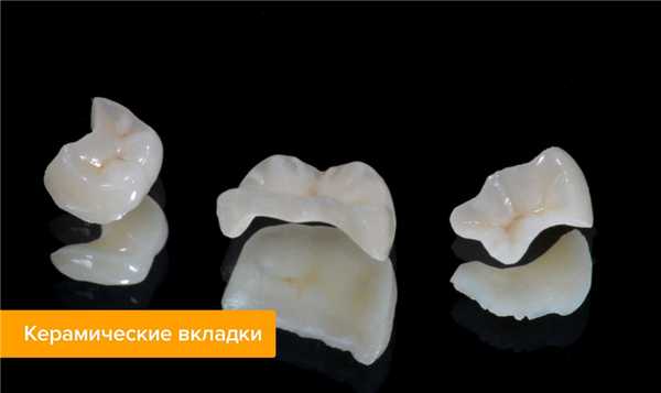 Фото керамических вкладок