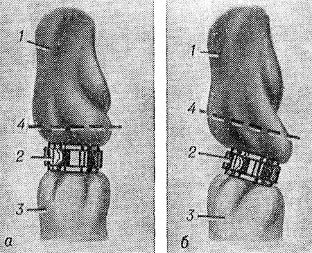 Рис. 2. Варианты наложения металлической скобы на пуповину по методу Роговина